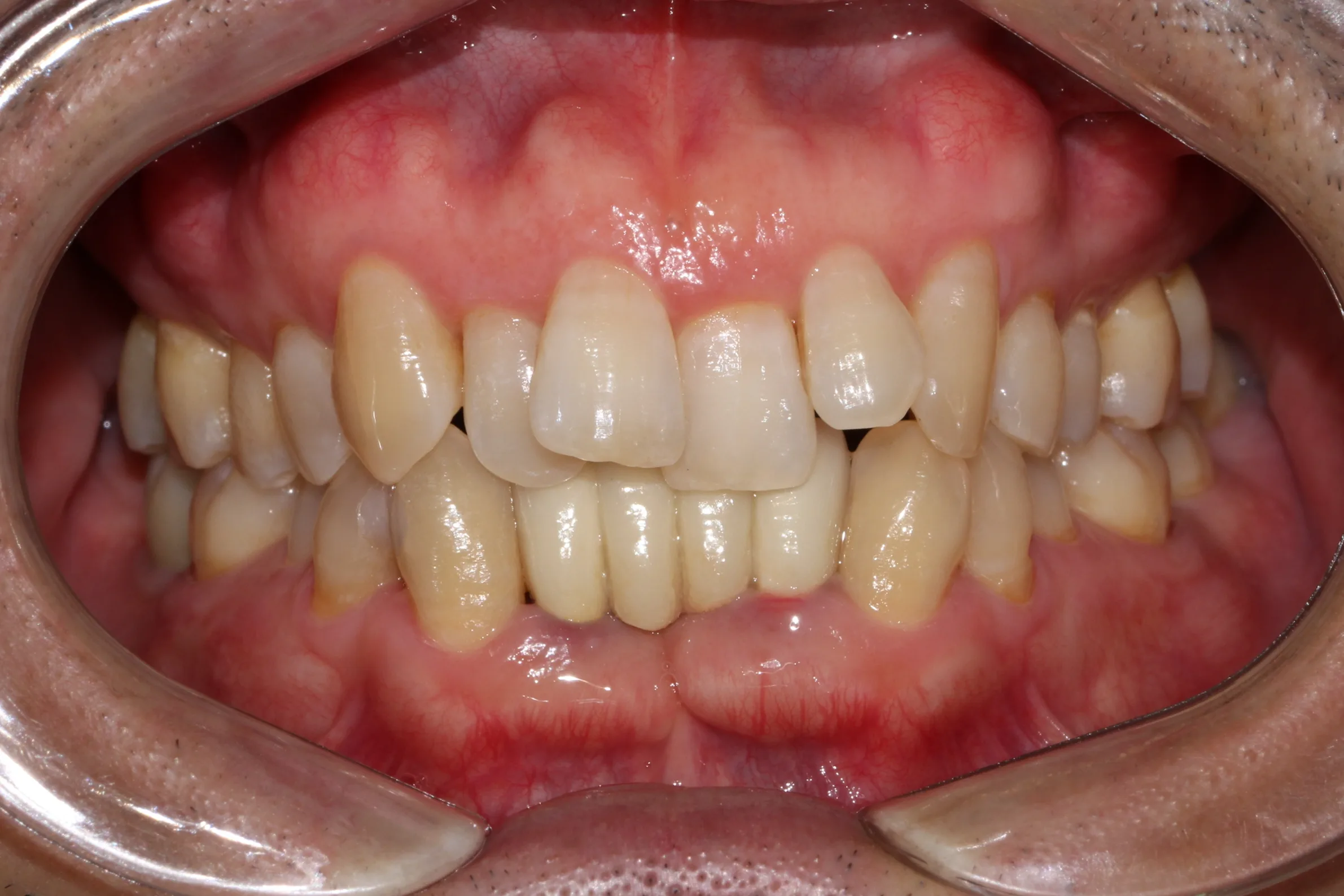 보철물 제약을 활용한 성인 인비절라인 교정