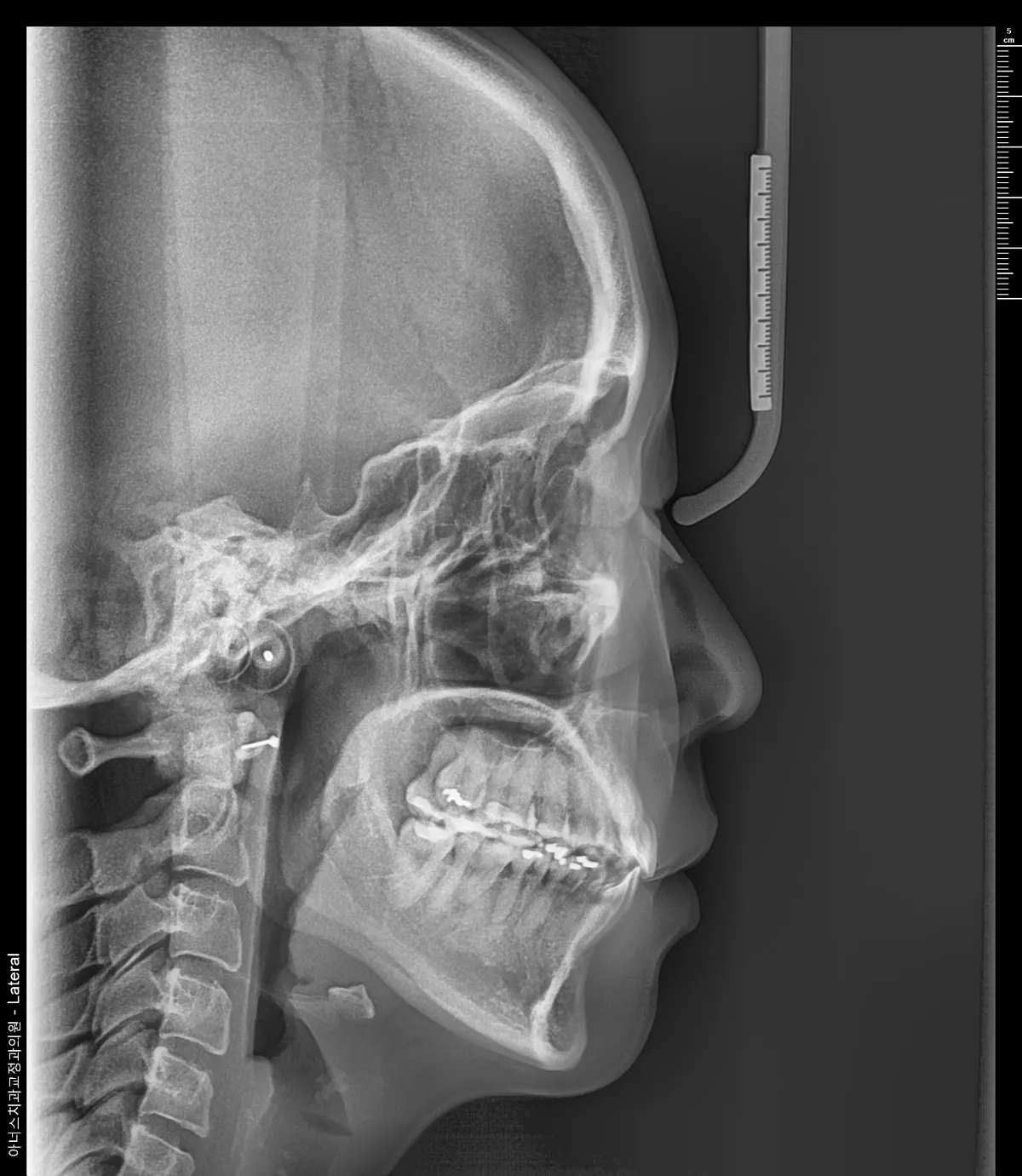 Lateral Ceph