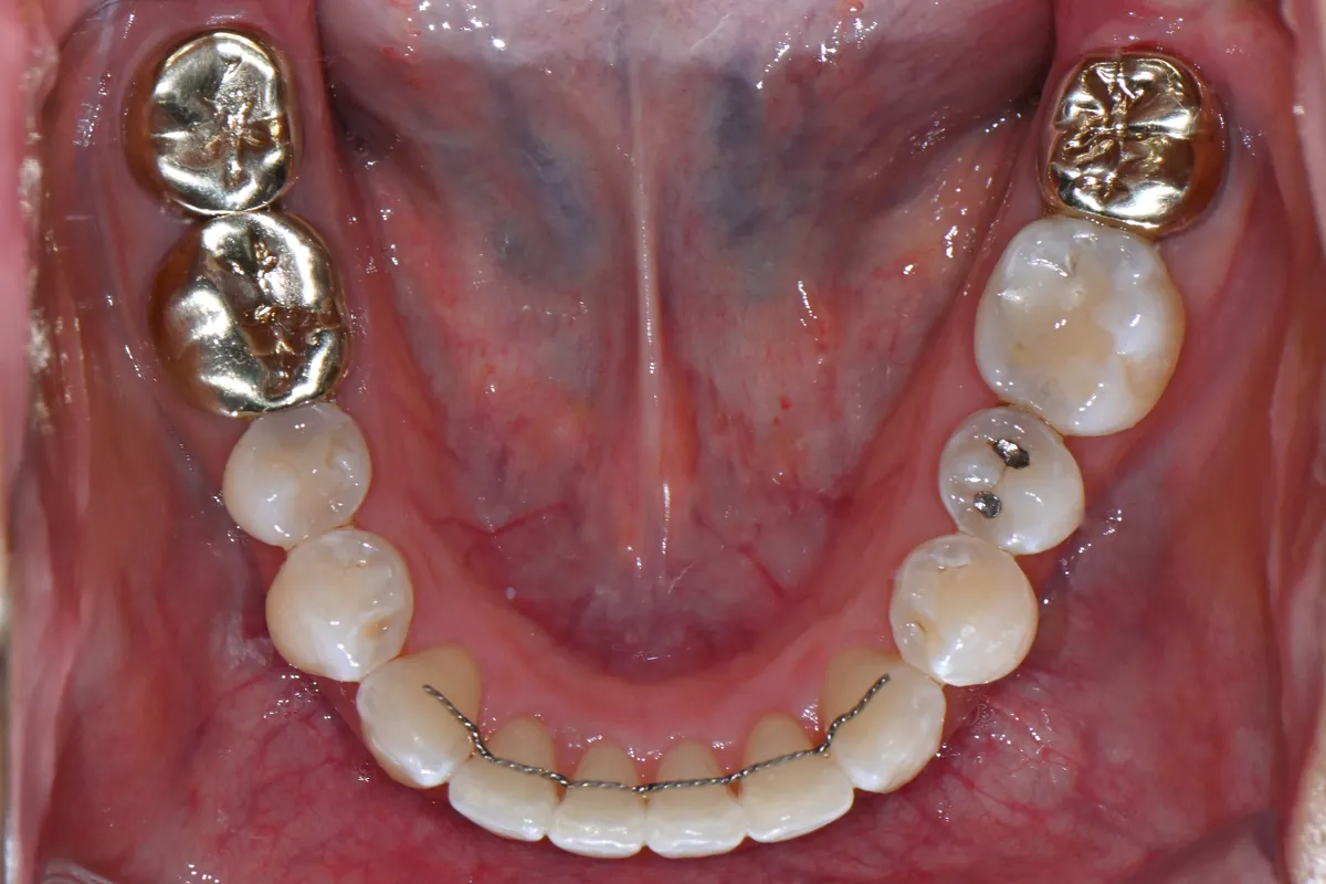 치료후 (After)