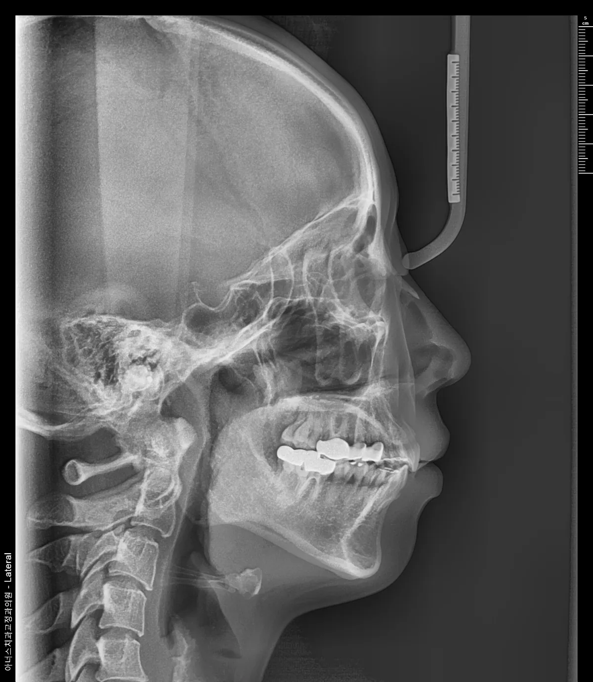 Lateral Ceph