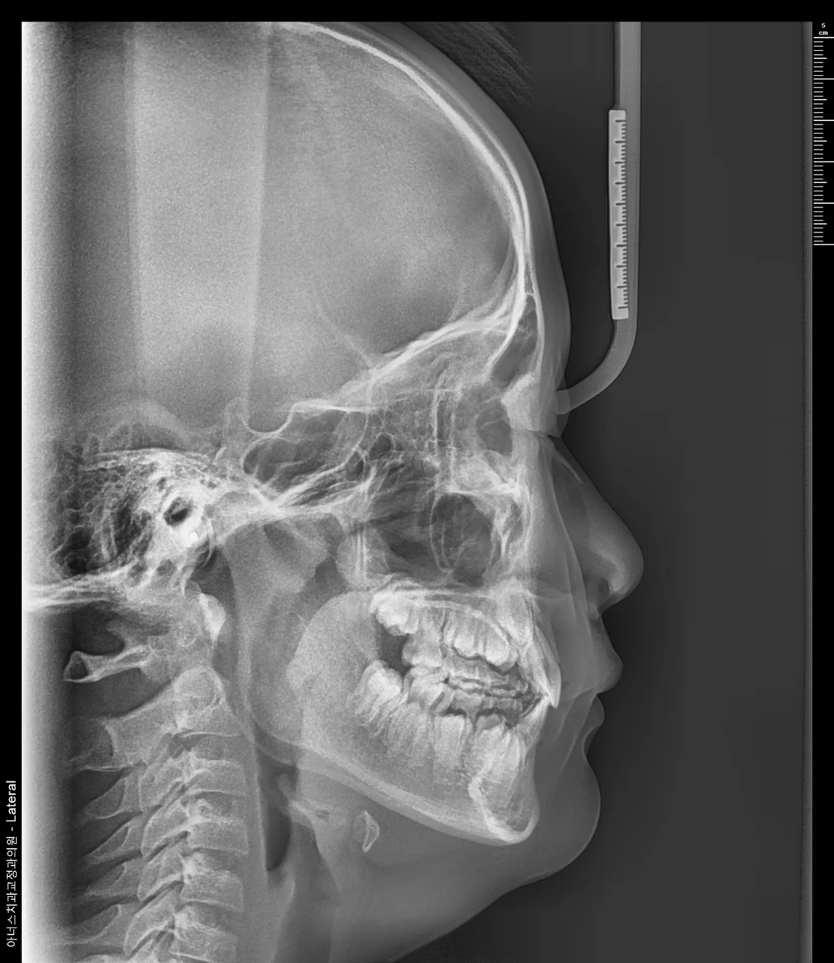 Lateral Ceph