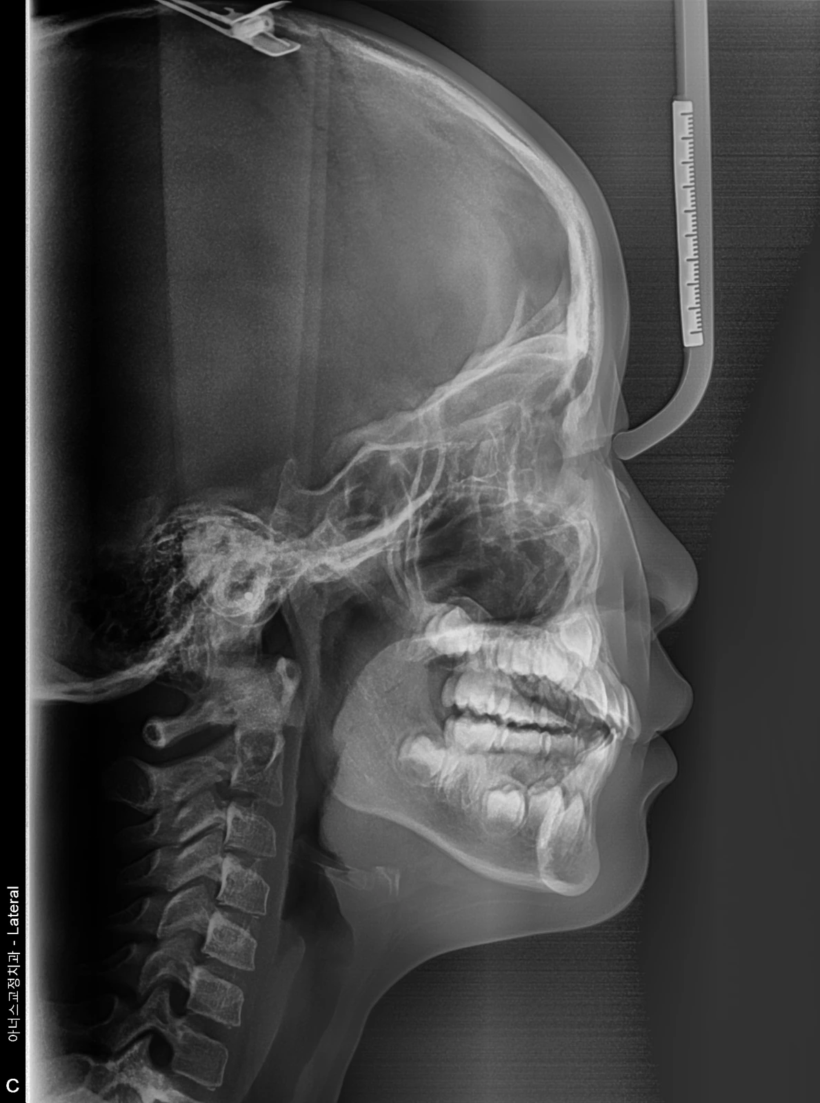 Lateral Ceph