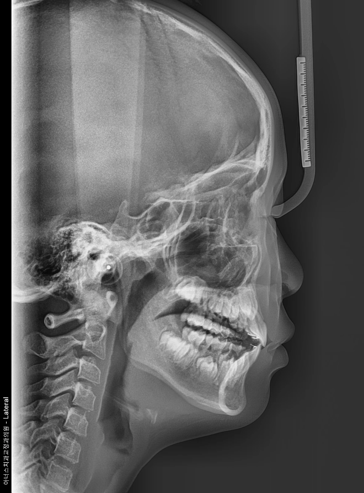 Lateral Ceph