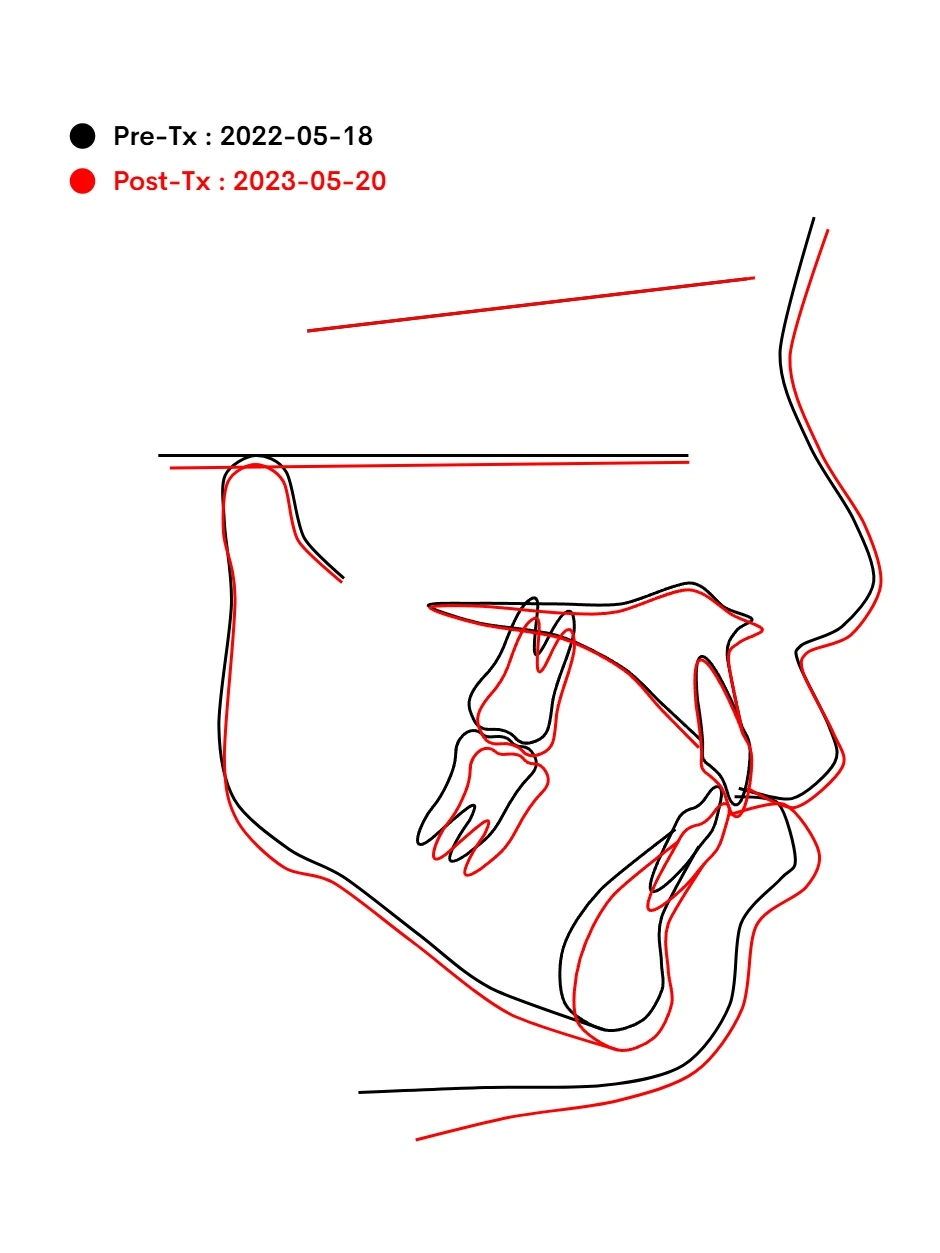 Superimposition