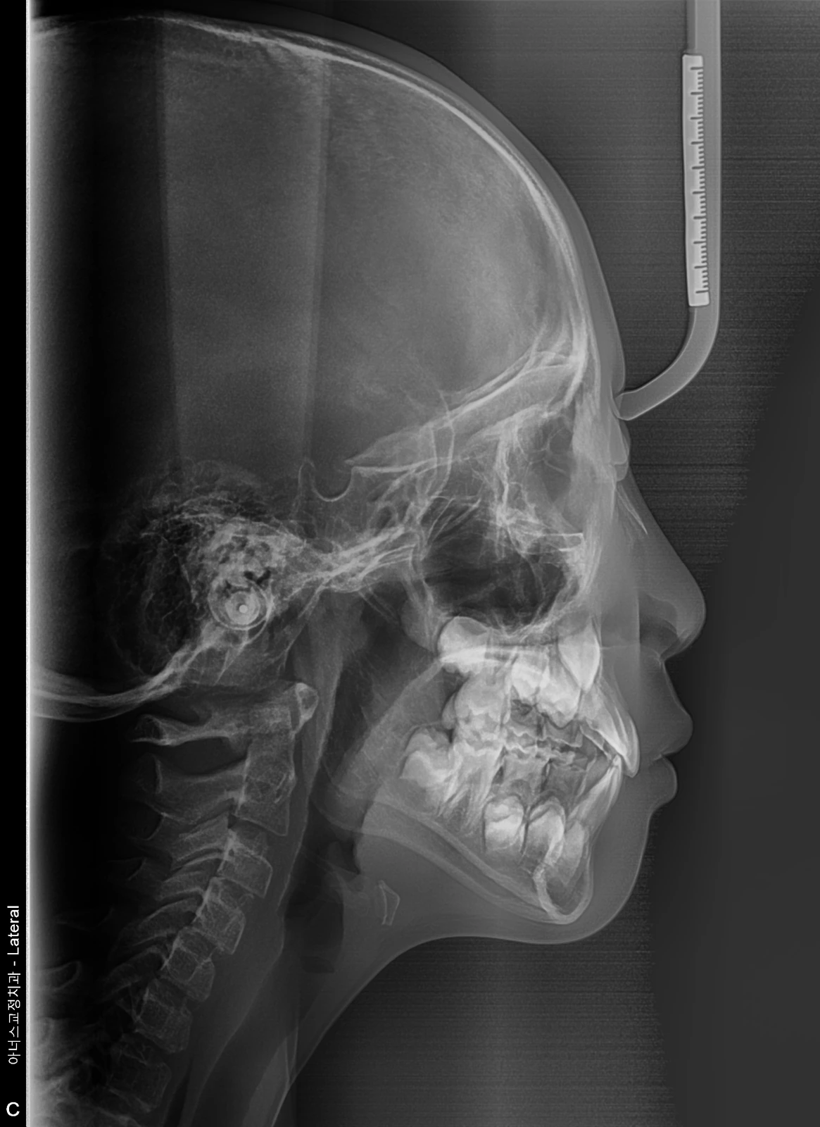 Lateral Ceph