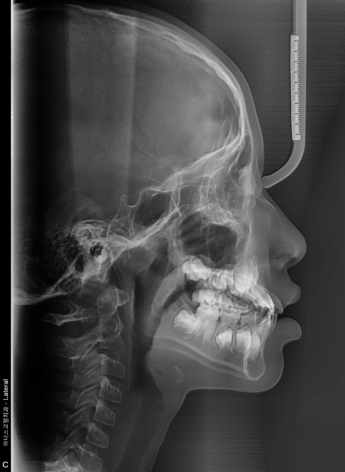 Lateral Ceph