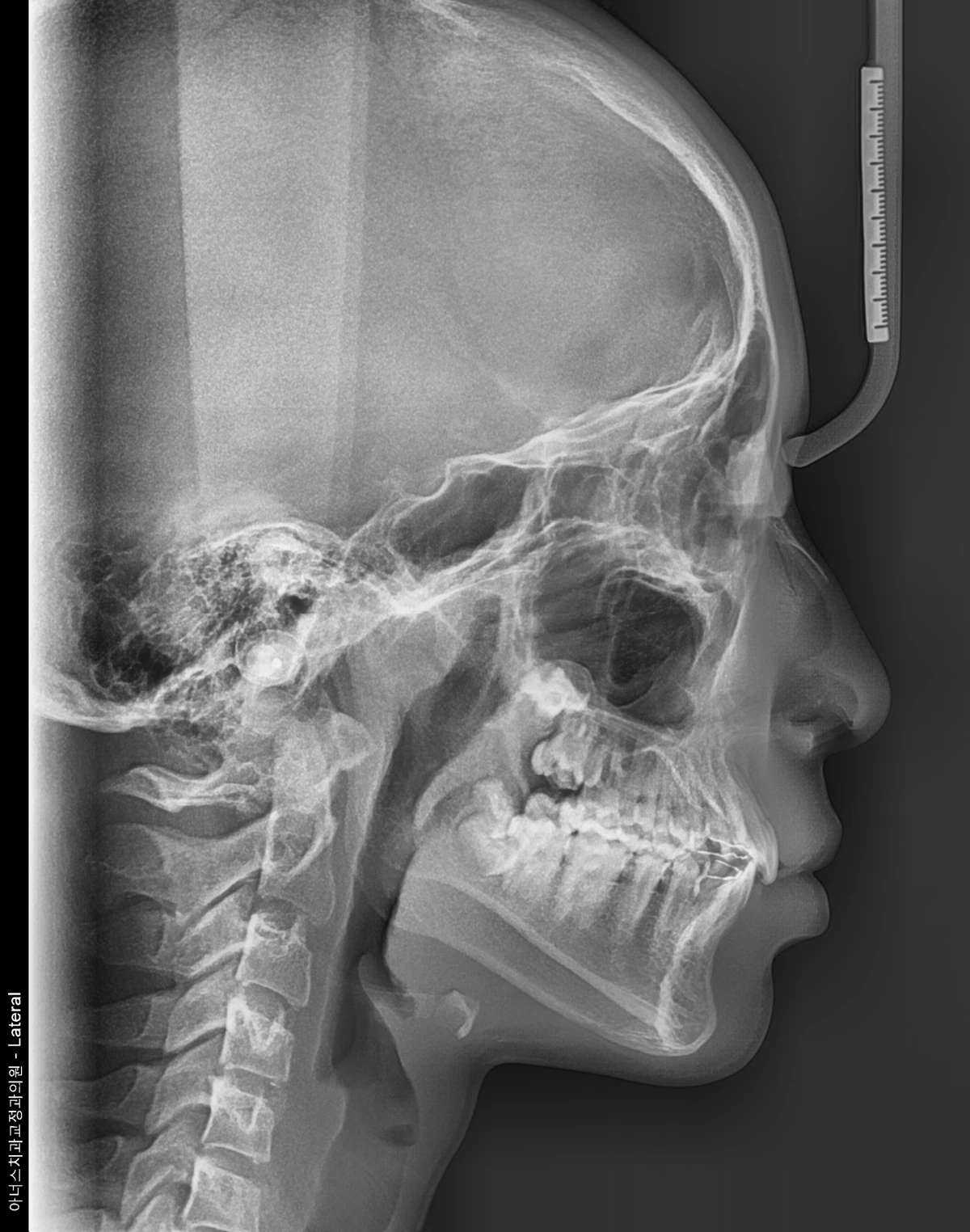 Lateral Ceph