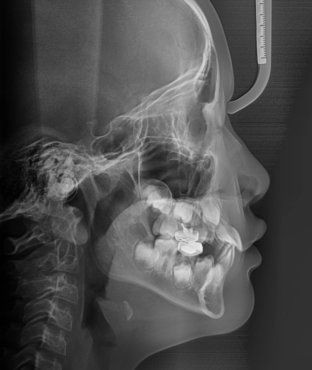 Lateral Ceph