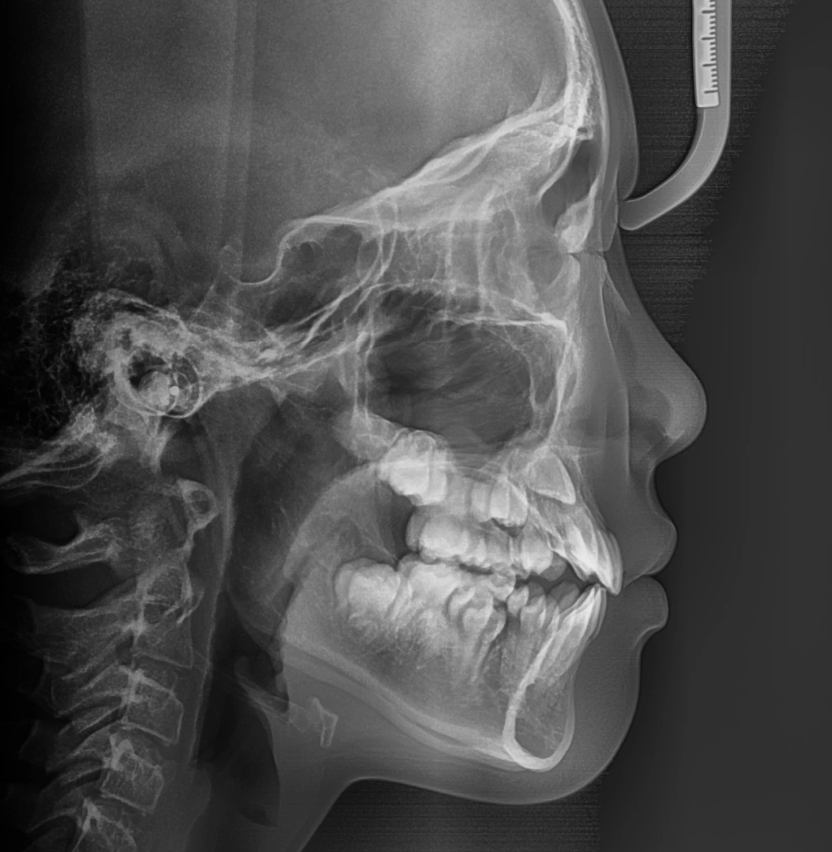 Lateral Ceph