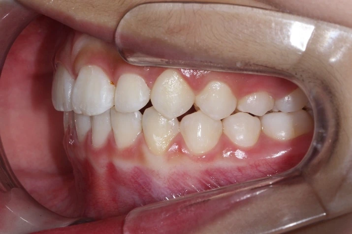 치료후 (After)