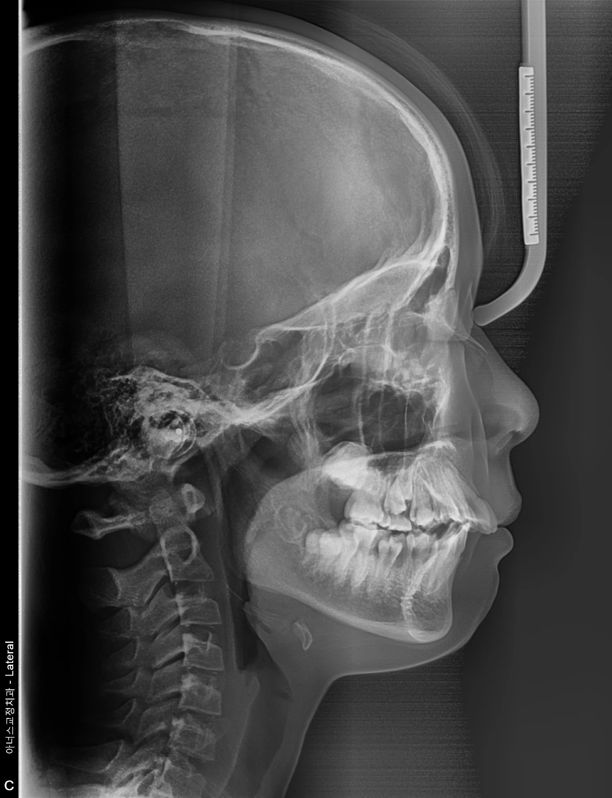 Lateral Ceph
