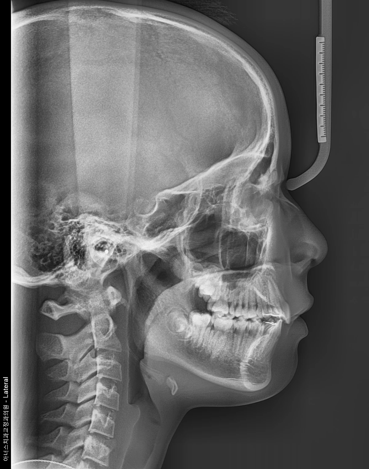 Lateral Ceph