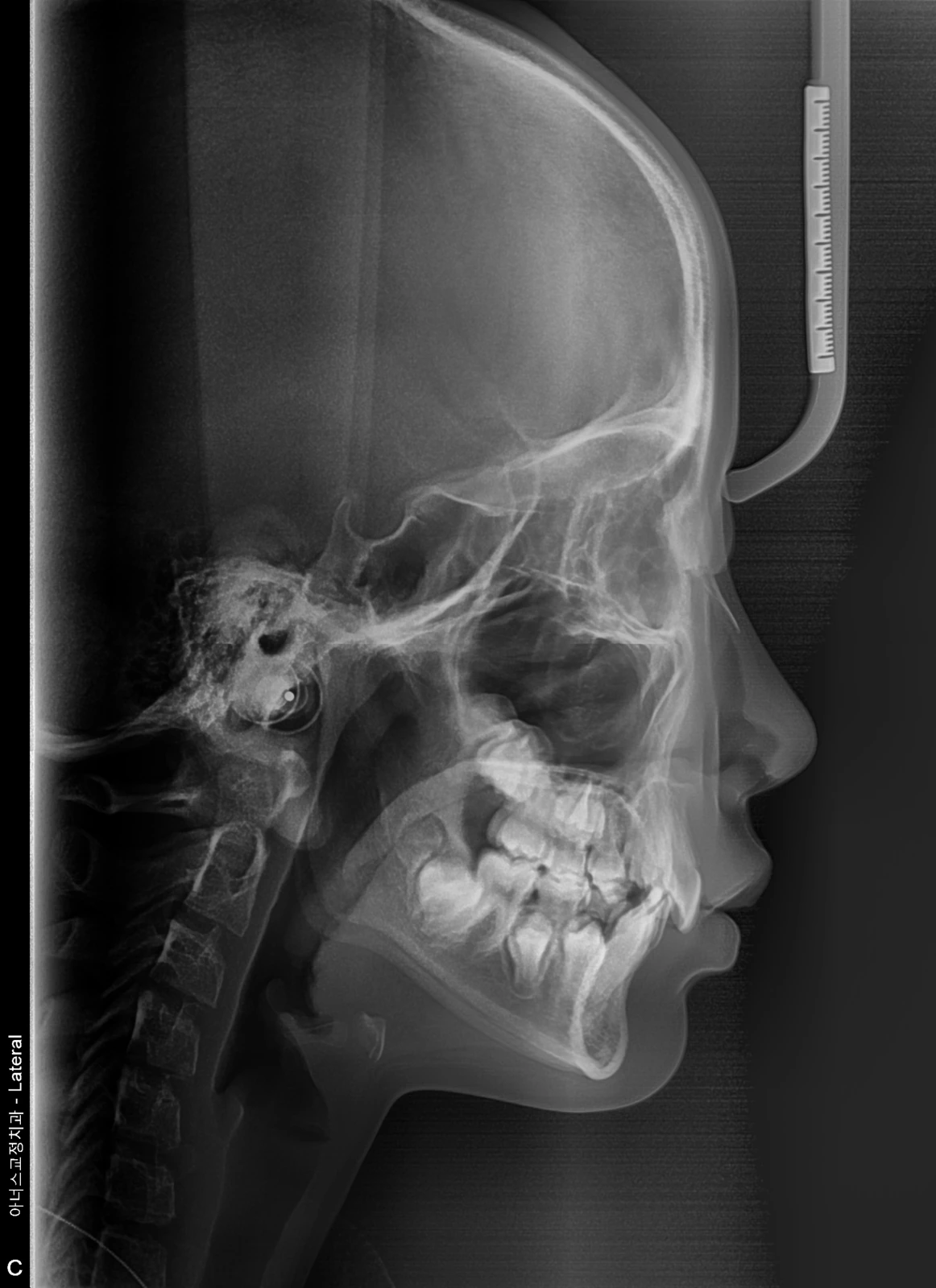 Lateral Ceph