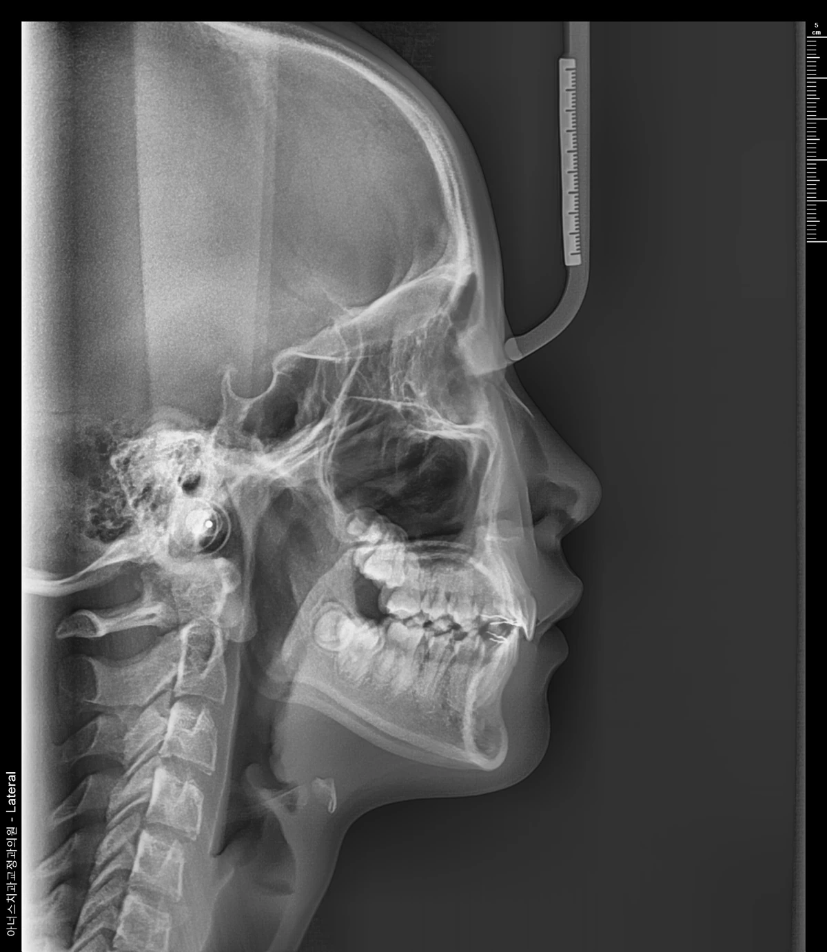 Lateral Ceph