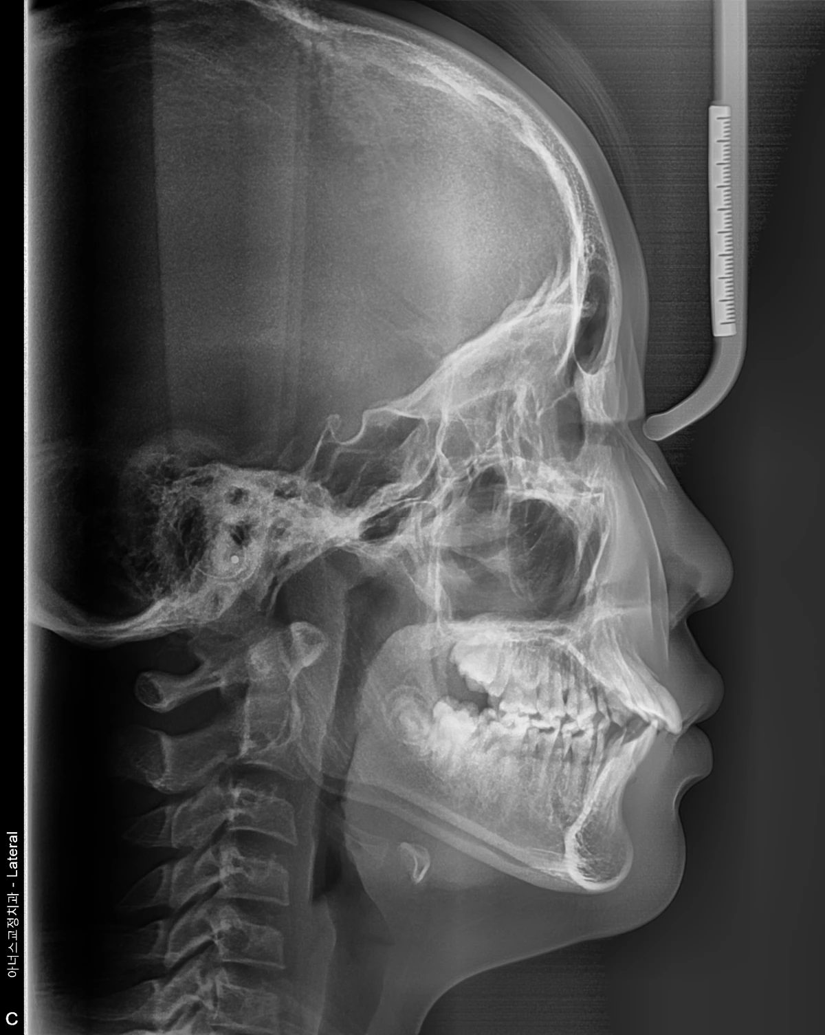 Lateral Ceph