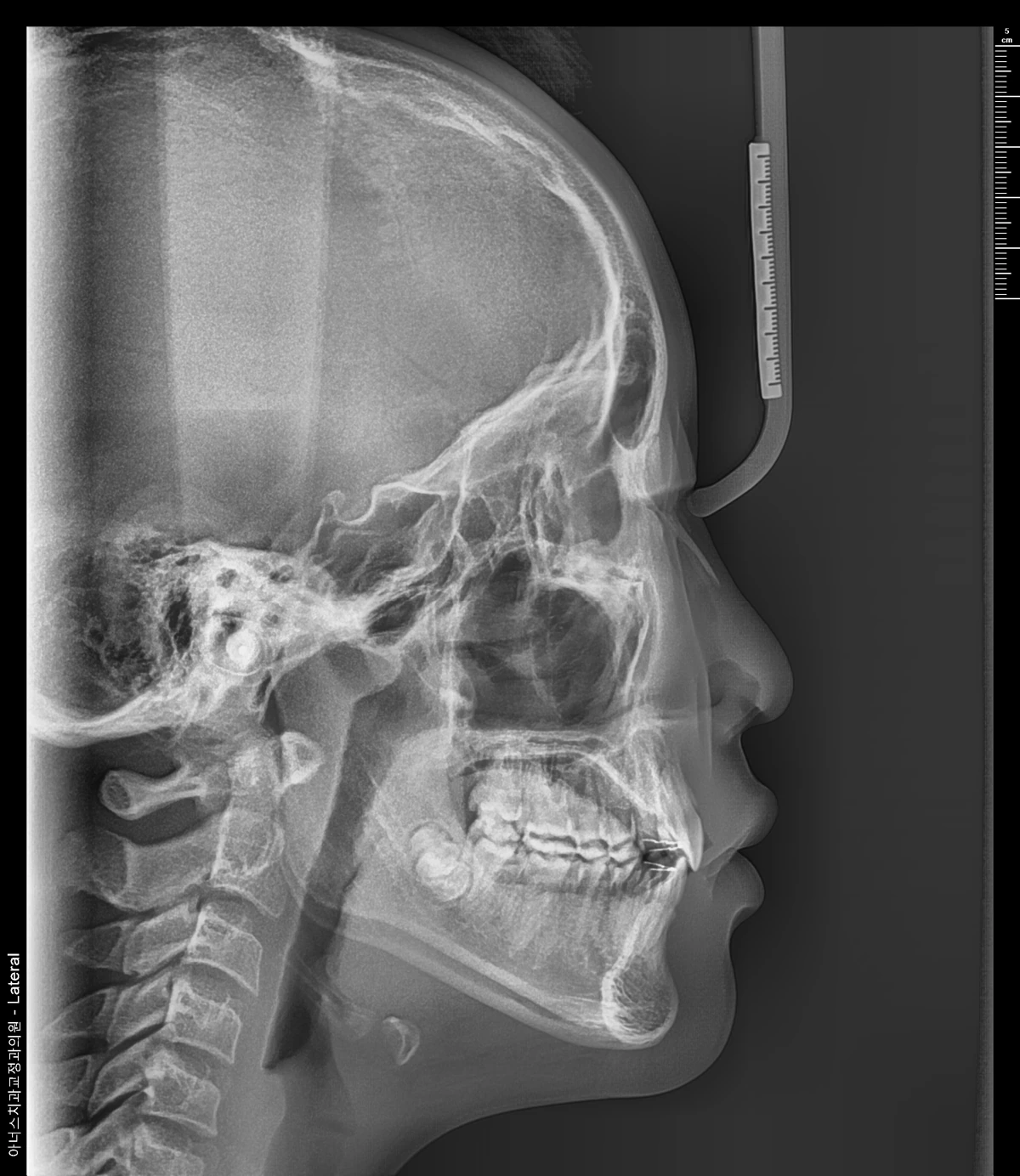 Lateral Ceph