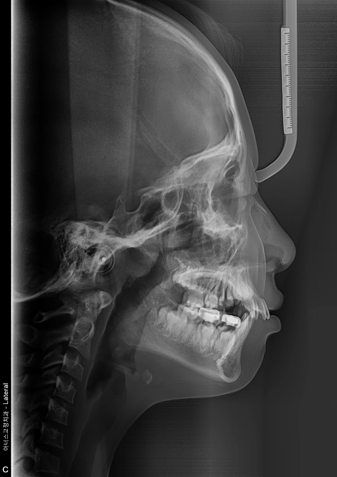 Lateral Ceph