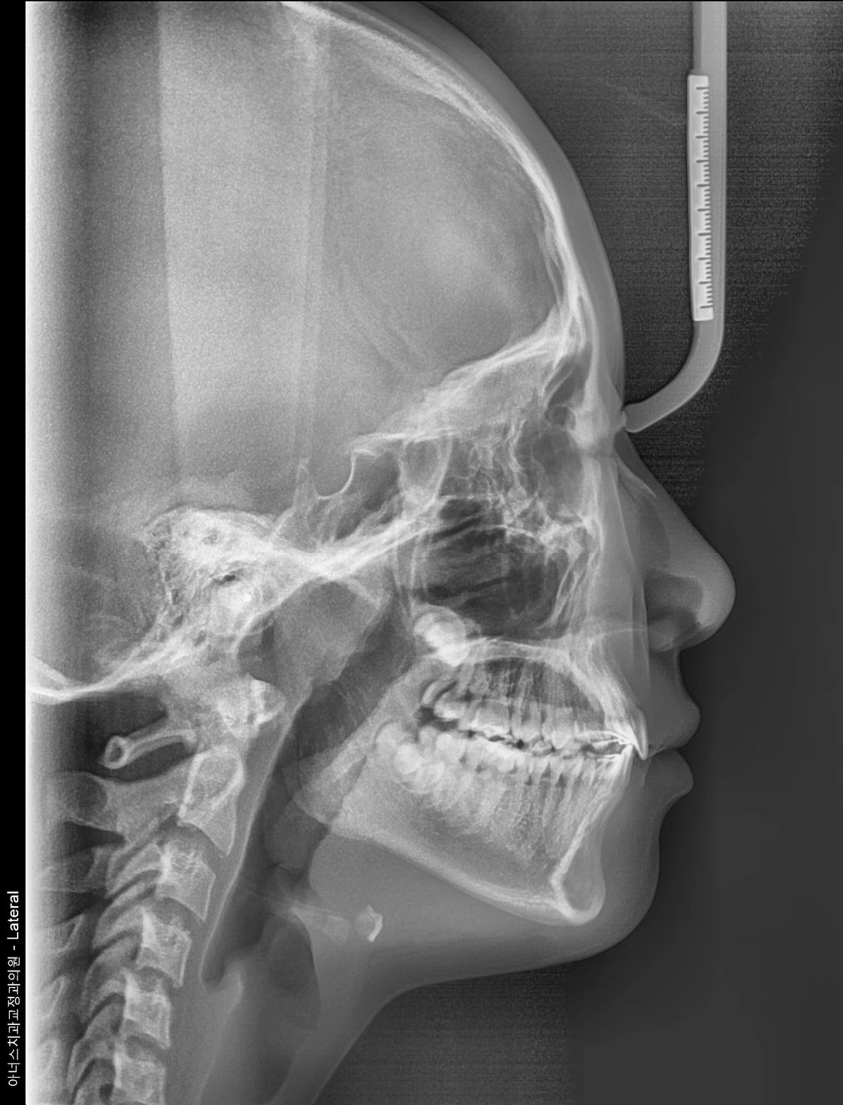 Lateral Ceph