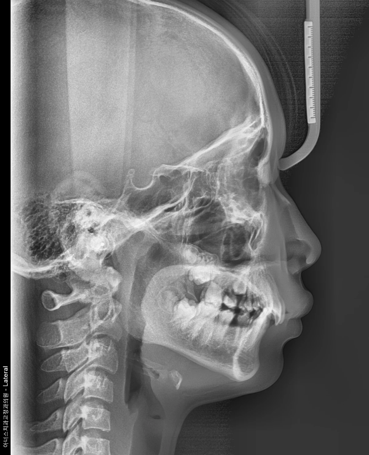 Lateral Ceph