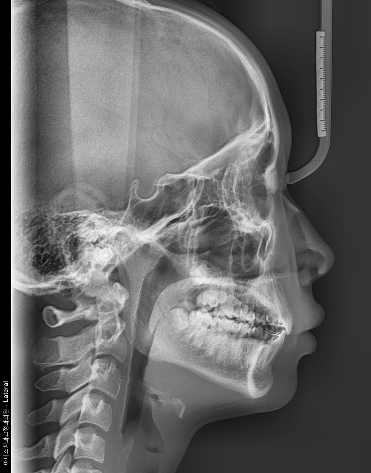 Lateral Ceph