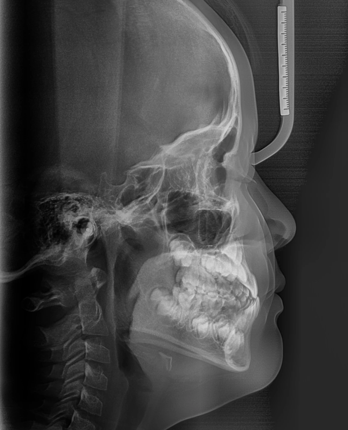 Lateral Ceph