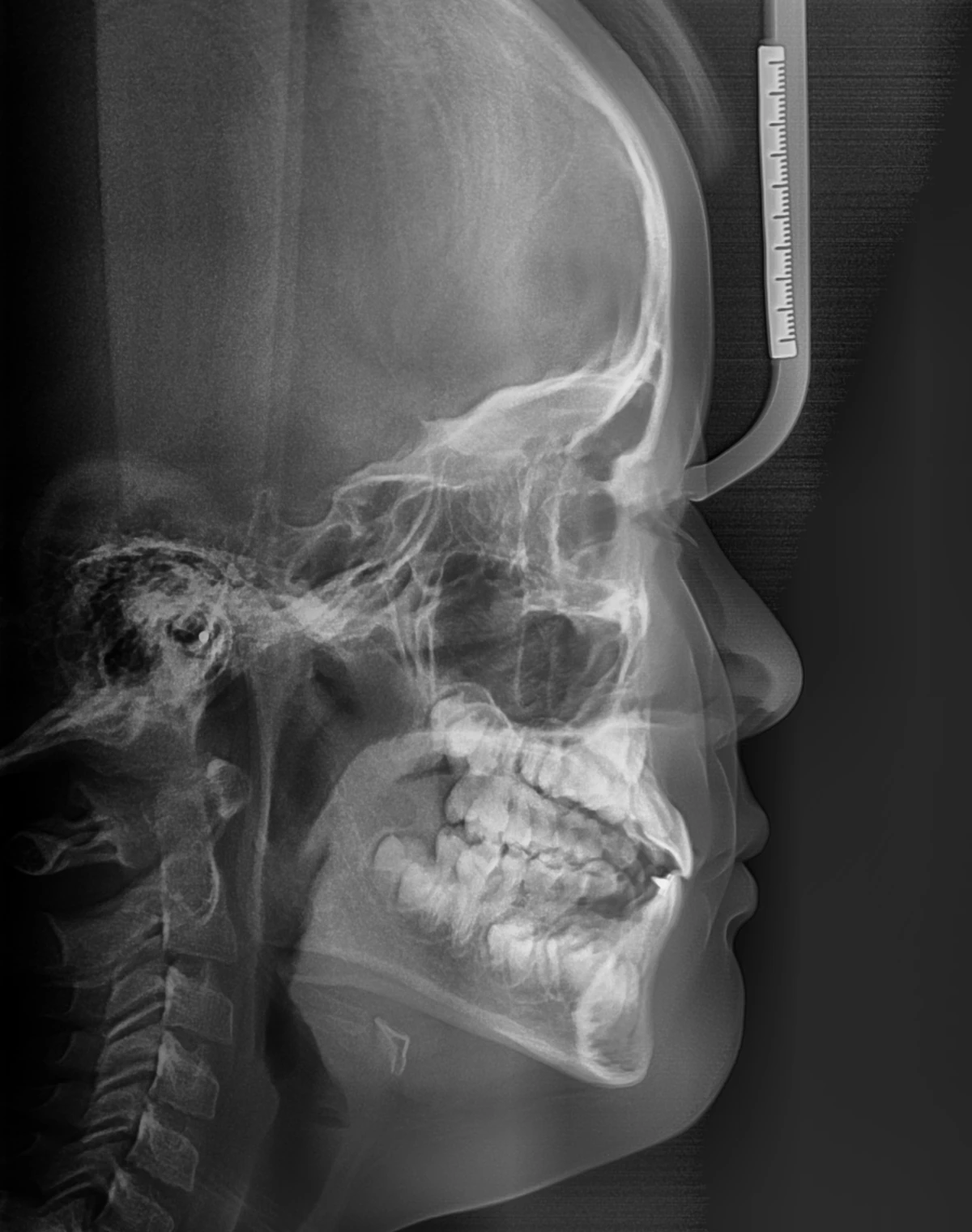 Lateral Ceph
