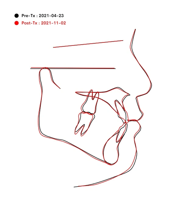 Superimposition
