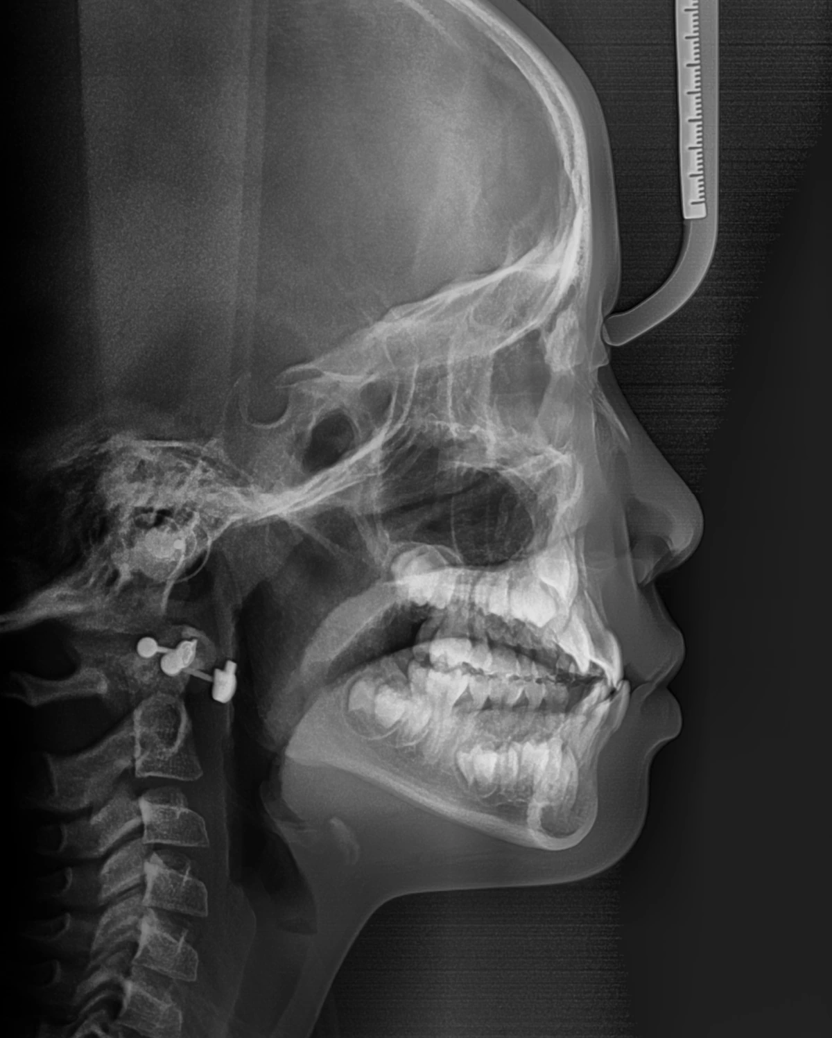 Lateral Ceph