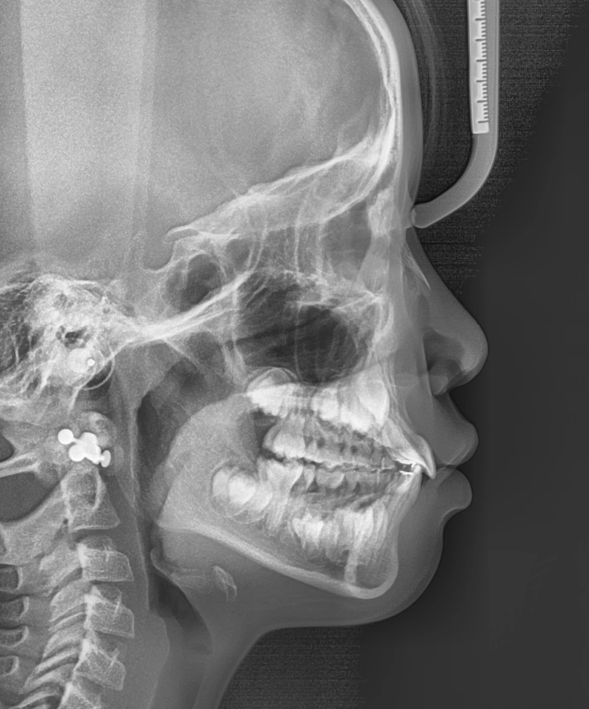 Lateral Ceph