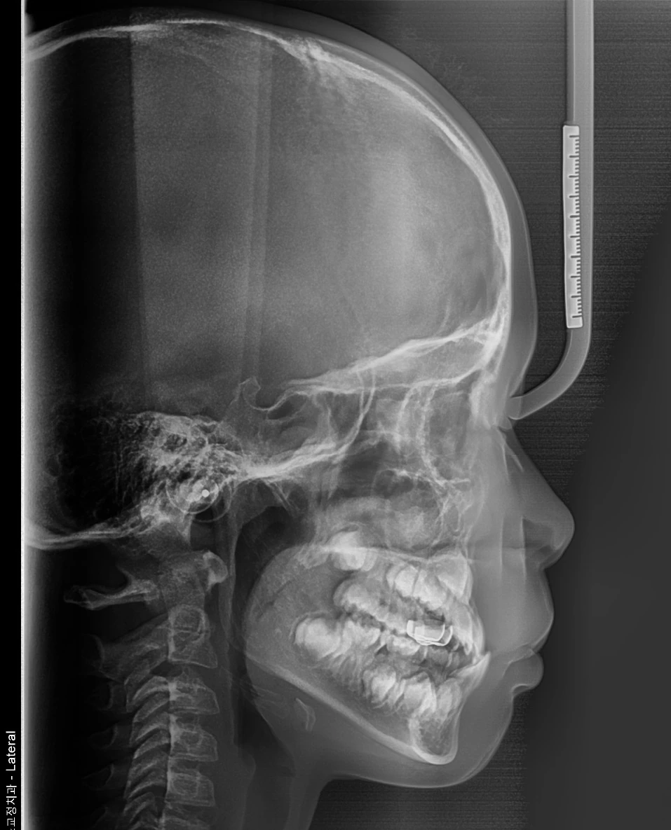 Lateral Ceph