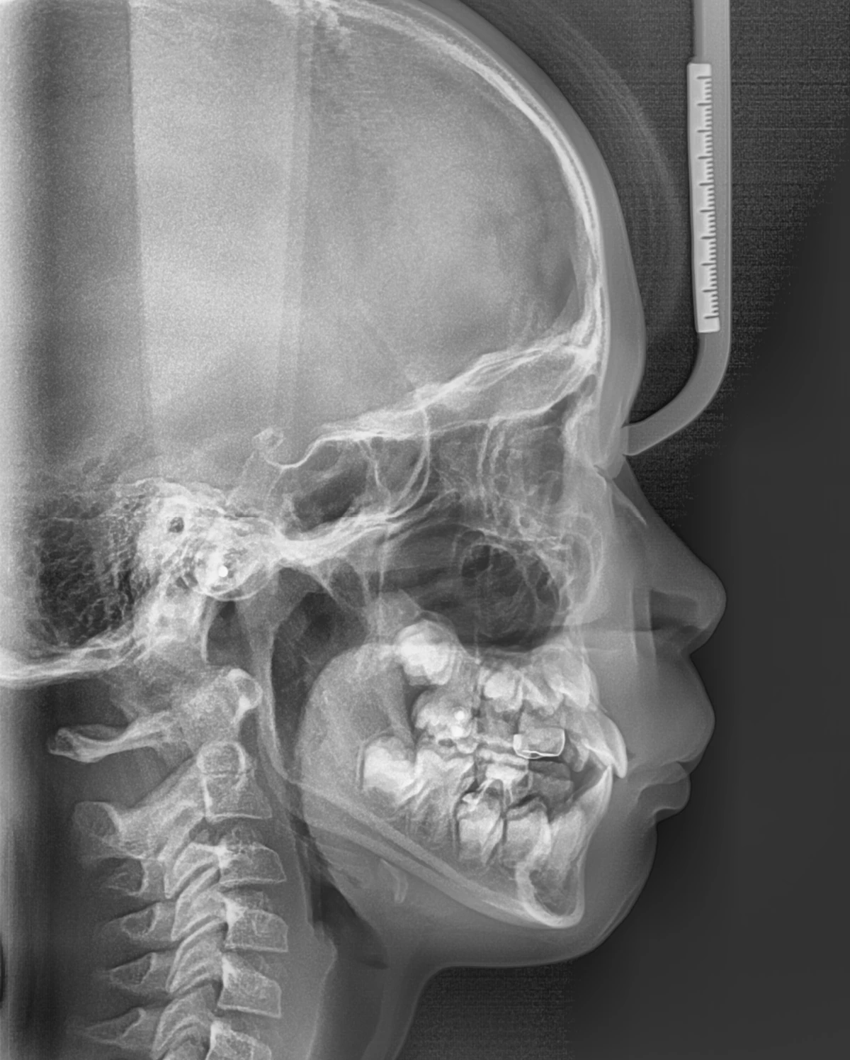 Lateral Ceph