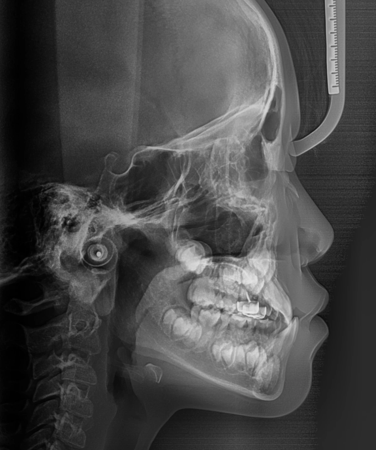 Lateral Ceph