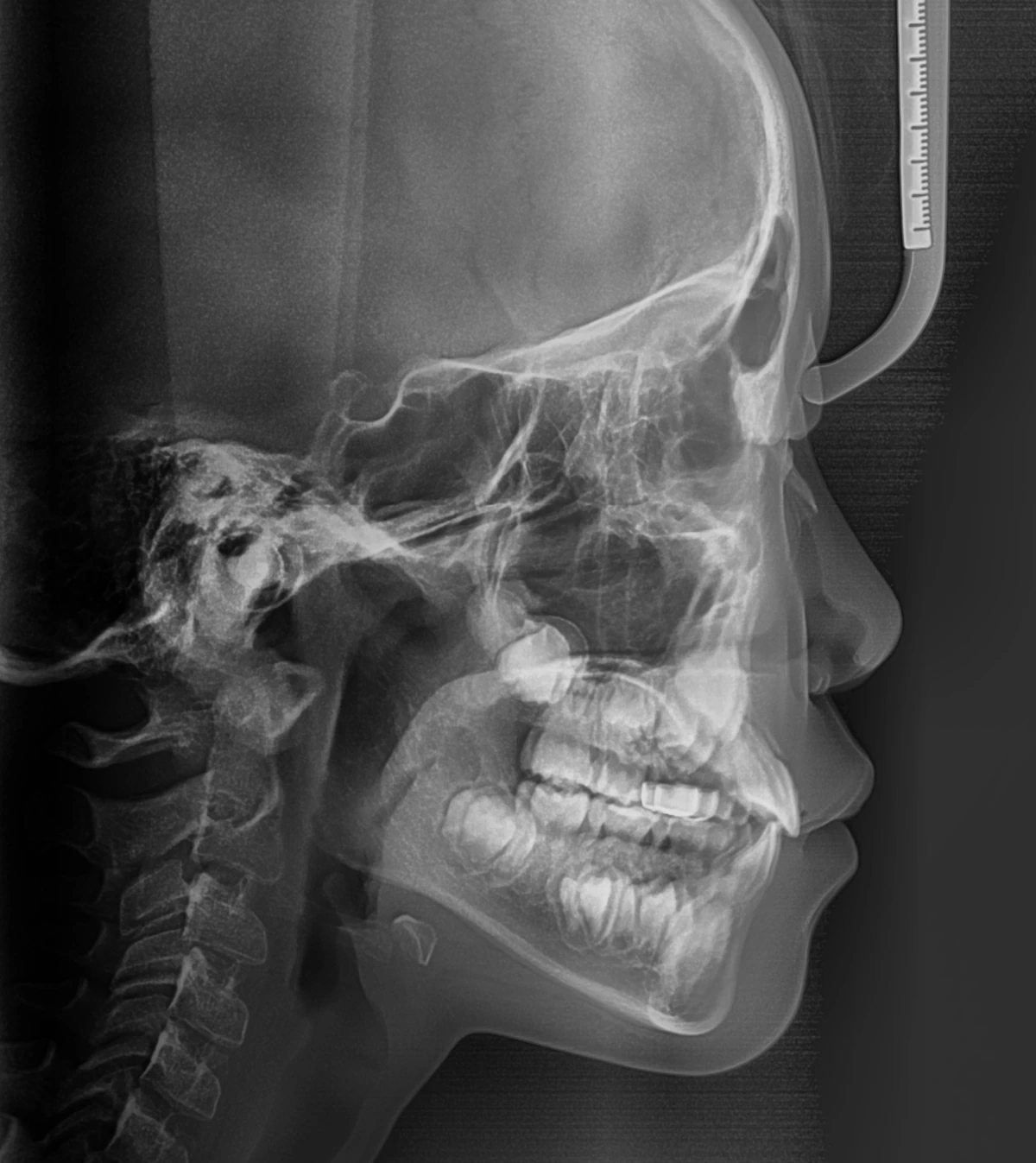 Lateral Ceph