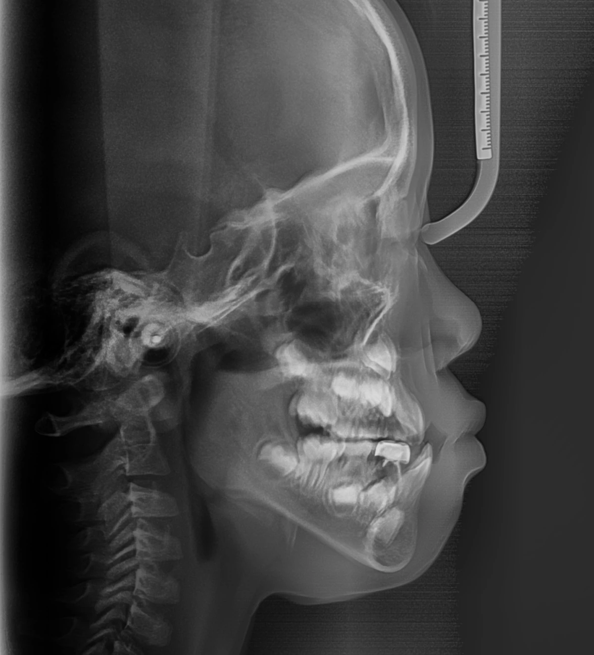 Lateral Ceph