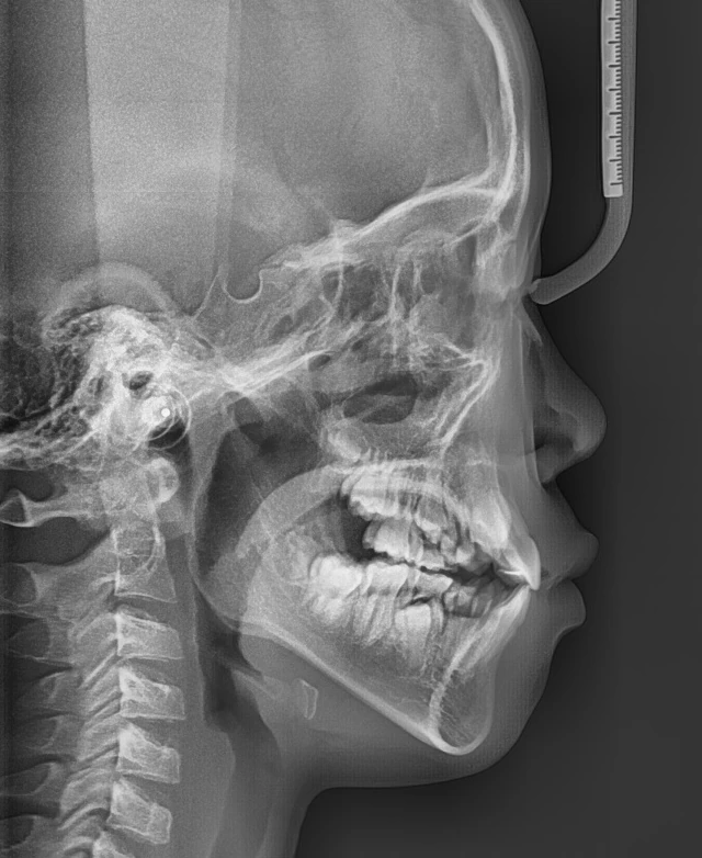 Lateral Ceph