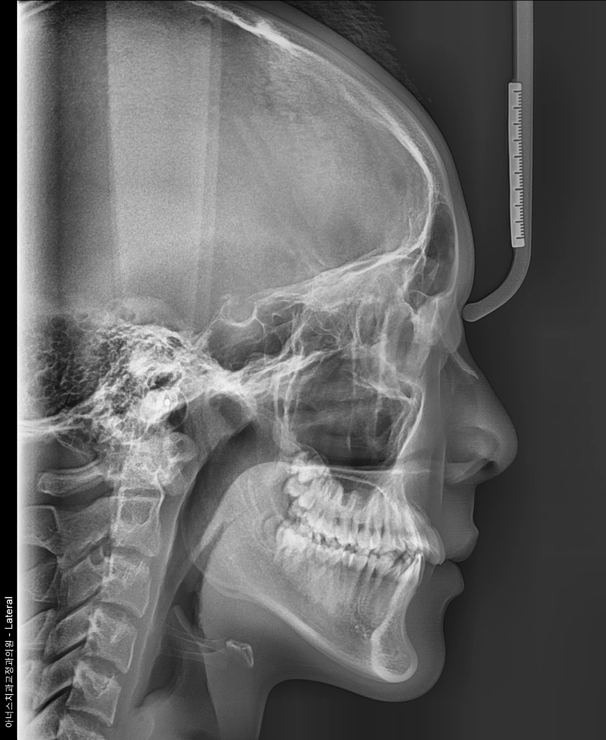 Lateral Ceph