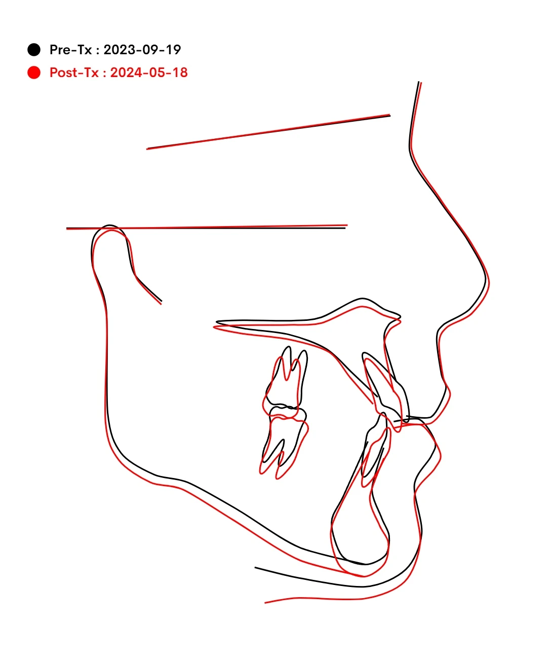 Superimposition