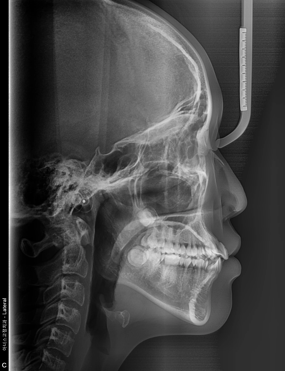 Lateral Ceph
