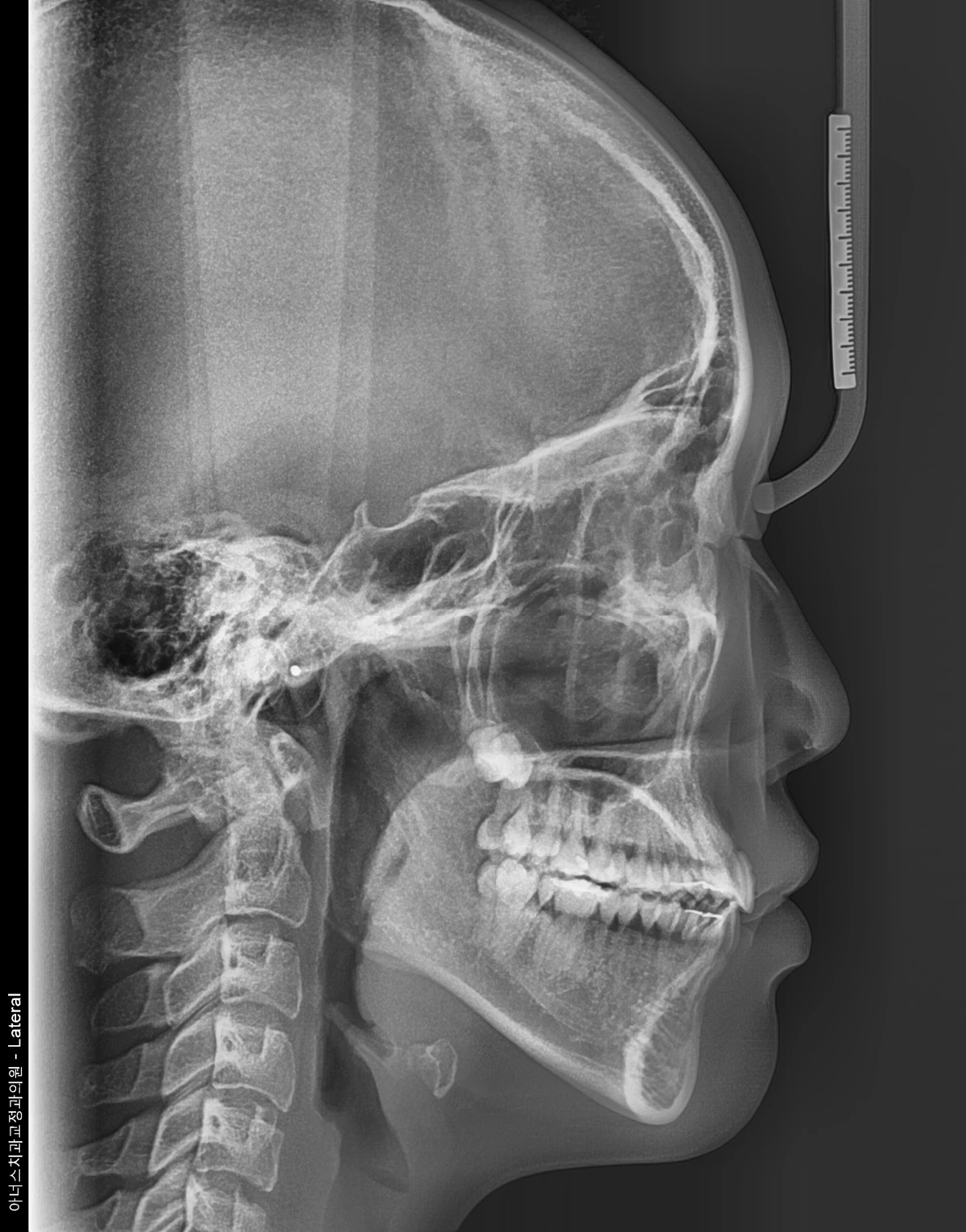 Lateral Ceph